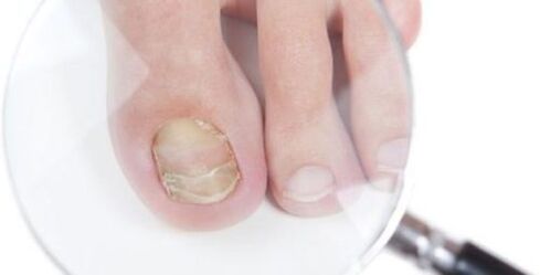 Diagnosis of mushroom