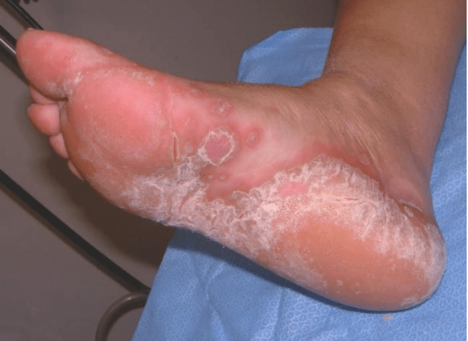 Determine the foot mushroom of the foot