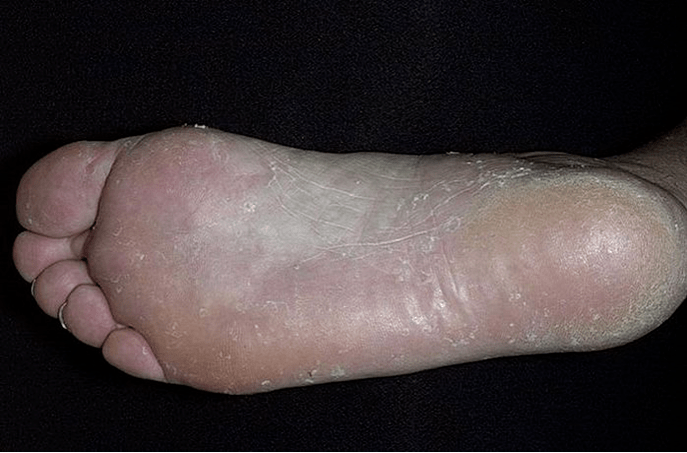 The mushroom of the foot
