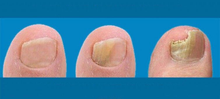 Development process for nail fungus