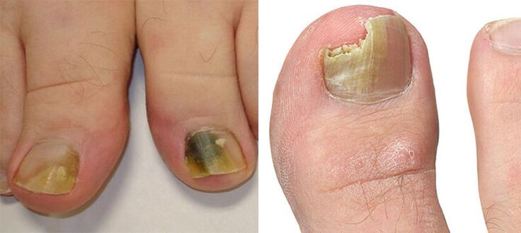 Onychomycosis - destruction of nails with a mushroom