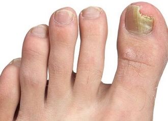 Symptoms of nail fungus