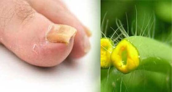 Celandine herb against toenail fungus
