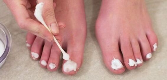 Treating toenail fungus with ointment