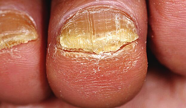 Advanced fungus on toenails