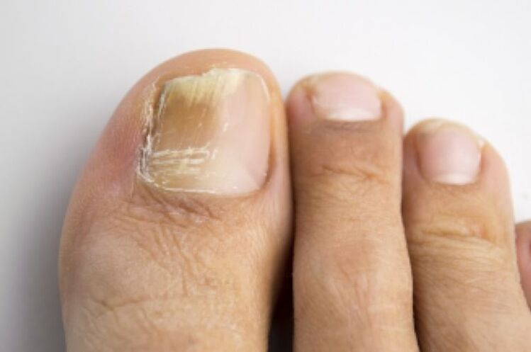 Fungal infection of the toenails
