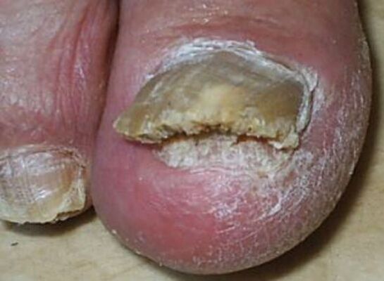 Photo of nail fungus