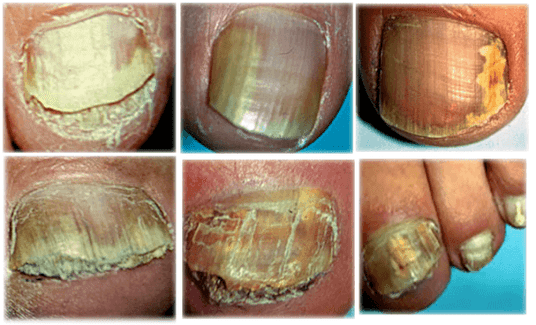 Types and forms of fungi on toenails