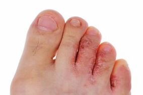 Fungal infection of the toes