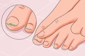 Fungal nail infection