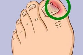 Ingrown toenail due to toenail fungus