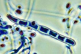 Nail fungus pathogens under the microscope