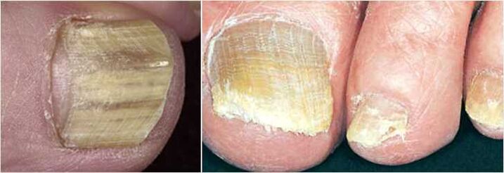 Fungus on toenails
