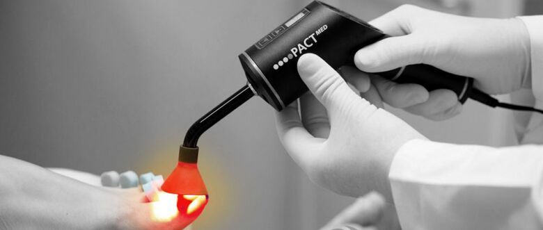 Laser treatment for fungus on toenails