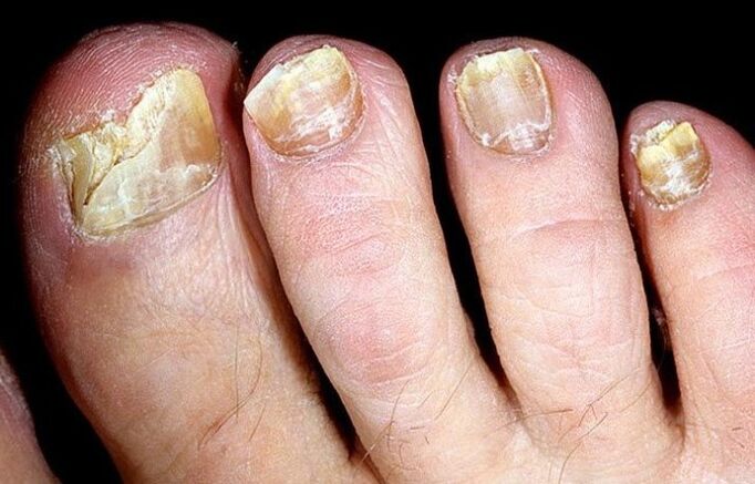 Advanced toenail fungus requiring complex treatment