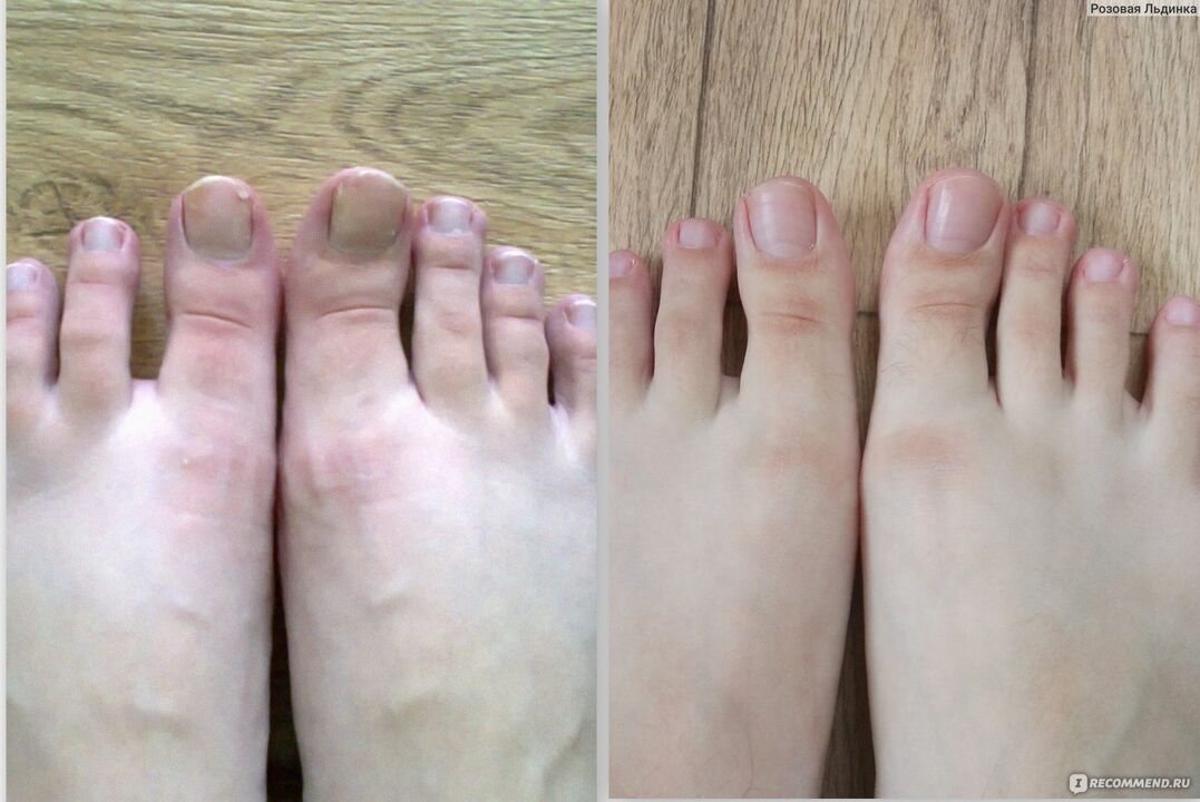 before and after a fungal treatment with Fungostop Plus cream